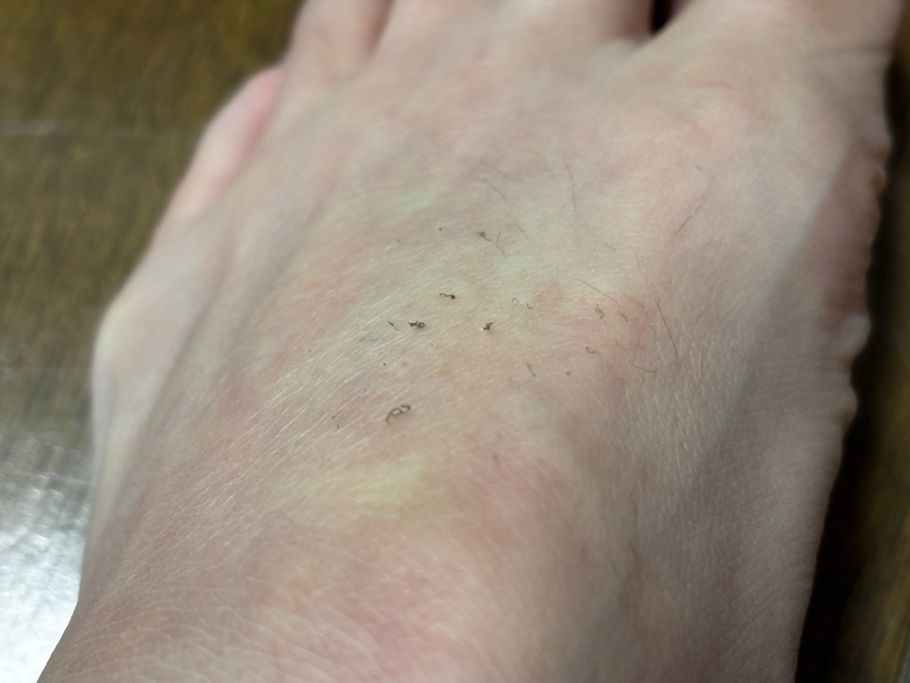 ケノンを当てたあとの足の甲。ちぢれた毛が肌の上にのっている